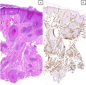 A) Imagen microscópica de un caso con patrón histológico de angiomatosis prurigiforme, en la que se observa una marcada proliferación vascular en dermis superficial, media y profunda, que plantea el diagnóstico diferencial con un tumor vascular (hematoxilina & eosina, x40). B) Tinción inmunohistoquímica frente a CD31 que confirma los hallazgos observados (x40).