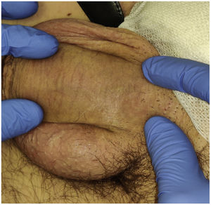 Imagen clínica del cordón subcutáneo indurado. Dicho cordón seguía un trayecto lineal a lo largo del dorso del pene y tenía una amplitud de 4mm.
