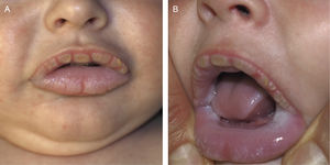 Placas blanco-amarillentas hiperqueratósicas que afectan la totalidad de la mucosa labial externa (A). Placas blanquecinas bilaterales y simétricas, de aspecto aterciopelado, en la mucosa yugal, labial interna y lingual lateral (B).