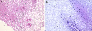 Biopsia de la mucosa yugal. Se evidencia principalmente acantosis, edema intracelular en los queratinocitos y disqueratosis (HE).