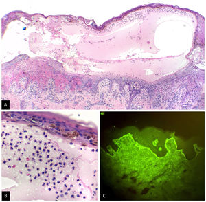 Biopsia de piel. A) Ampolla subepidérmica, H&E×4. B) Infiltrado inflamatorio rico en neutrófilos, H&E×40. C) Inmunofluorescencia directa, H&E×40. IgA+ en patrón lineal en la zona de la membrana basal.