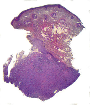 Imagen histopatológica de la biopsia cutánea de la lesión (H&E, ×4). Se observa la proliferación nodular, localizada en la dermis profunda.