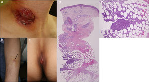 (a) Well-demarcated deep ulcer on the central vein catheter insertion site. (b) Painful erythematous nodules on the forearm (arrow). (c) Ulcerative lesion on the sacral area. (d) Histopathology examination showing lobular panniculitis (H–E, ×20). (e) Higher magnification showing neutrophil infiltration inside the fat tissue (H–E, ×200).
