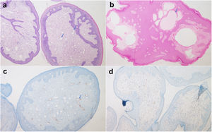 Microscopic findings of lymphangioma circumscriptum. (A and B) Histopathology examination revealing the presence of a polypoid lesion with dermal vascular proliferation and dilated vessels outlined by a single layer of endothelial cells (see arrows). (C) Patched positivity for D2-40. (D) Progesterone receptors expressed by stromal cells.