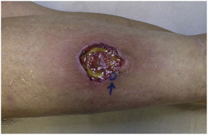 Úlcera de bordes violáceos mal definidos y fondo fibrinoide en cara anterior de la pierna.