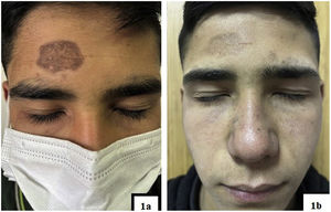 (A) Brown to gray patch lesion on the forehead. (B) Faded lesion after 1 year of treatment.