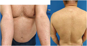 Patient before starting dupilumab. Note the areas of eczema, and the presence of body hair.