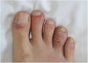 Dactilitis del cuarto dedo del pie derecho (caso 3).