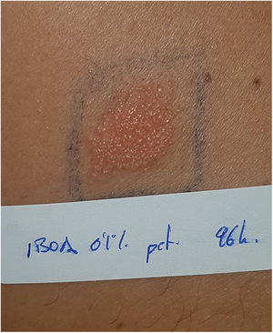 Positive patch test for IBOA at 96hours in a patient with FreeStyle Libre® sensor-induced contact dermatitis.