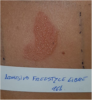 Positive reaction at 96hours to the adhesive of the FreeStyle Libre® sensor (same patient as in Figure 1).