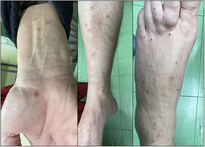 Three-week history of erythematous papular lesions on legs and arms.