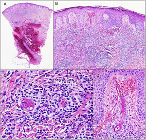 The biopsy revealed the presence of a dense inflammatory infiltrate on the superficial and mid dermis composed mainly of lymphocytes (A, B). Images of lymphocytic vasculitis were seen, with endothelial tumefaction, luminal thrombotic occlusion, fibrin deposition, and red blood cell extravasation (C, D).