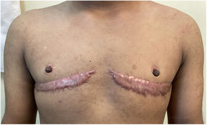 Queloides. Cicatrices lineales queloides en zona pectoral posterior a cirugía de masculinización de tórax en hombre trans.