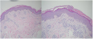 Biopsia cutánea de lesión papulosa. Tinción con hematoxilina-eosina. Se observa un infiltrado dérmico perivascular mononuclear, zonas de paraqueratosis y queratinocitos disqueratósicos en las capas superficiales de la epidermis.