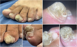 Case #1. Clinical appearance. (A–C) Hyperkeratotic tumor deforming and changing the nail plate. Dermoscopy of the tumor: (D–F) black dots and short lines consistent with splinter hemorrhages.