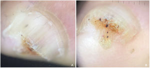 Case #2. Dermoscopy. (A) Yellow chromonychia and splinter hemorrhages on the left 4th toenail. (B) Onychoscopy of the free edge showing thickening of the central nail plate, black-reddish dots, and lines over an orange background. The ventral portion of the tumor resembles a ventral pterygium.