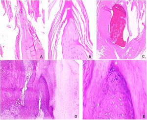 Case #1. Pathology. 10×, 40× and 40× (A, B, C, respectively). Nail matrix with hyperkeratotic stratum corneum associated with parakeratosis, hemorrhagic foci, and serous exudate. Malpighi stratum displays papillomatosis and subtle koilocytic changes. Case #2. Pathology. 10× and 40× (D, E, respectively). Nail matrix with hyperkeratosis and parakeratosis, Malpighi stratum with papillomatosis, hypergranulosis, and koilocytic changes.