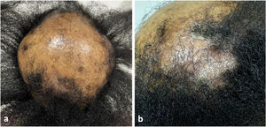 (a) Alopecia cicatricial frontoparietal intercalada con pápulas y placas escamosas eritematosas, rodeadas por cabellos ásperos y secos propios del lupus. (b) Placa alopécica eritematosa escamosa en la región parietal derecha del cuero cabelludo.