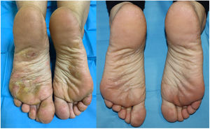 Eccema dishidrótico en plantas de los pies y pulpejos de los dedos con mejoría completa a los dos meses de tratamiento con dupilumab.