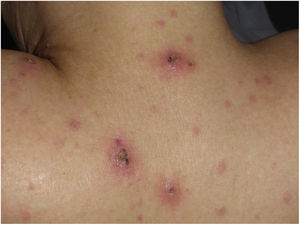 Clinical findings: abundant erythematous–edematous papules and plaques with vesicles and superficial crusts on the upper dorsal region.