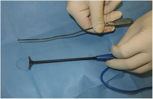 Material quirúrgico necesario para el destechamiento de una fístula de hidradenitis supurativa: un estilete y un asa diatérmica de conización (ginecológica).