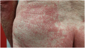 Non-involved skin islands in a patient with PRP.