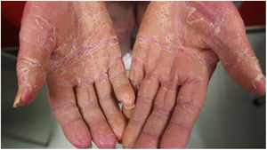 Palmoplantar keratoderma in a patient with PRP.
