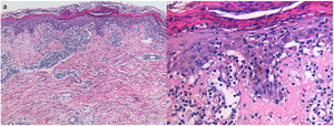 Hallazgos histopatológicos de la biopsia por punción de una pápula abdominal-H-E, 100× (a) y H-E, 400× (b), compatible con PLC. PLC: pitiriasis liquenoide crónica.