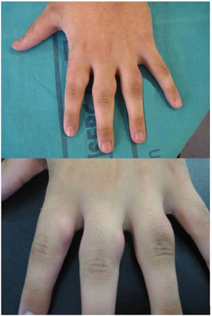 Edema del tejido blando en los dedos segundo, tercero y cuarto antes del tratamiento.