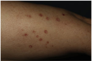 Clinical image. Multiple erythematous-violet, shiny, polygonal papules of up to 1cm in size located on both forearms.