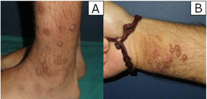 Clinical images representative of lesions located on the left ankle (“A”) and right forearm (“B”).