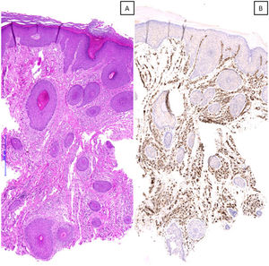 A) Microscopic image of a case with a histopathological pattern of prurigiform angiomatosis, showing a marked vascular proliferation on the superficial, mid, and deep dermis, suggesting the differential diagnosis of a vascular tumor (hematoxylin & eosin, x40). B) Immunohistochemical staining for CD31 confirming the observed findings (x40).