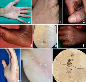 Clinical and microscopic images of scabies; a) classical form in a young adult with skin type 3 exhibiting the characteristic burrows (arrows) and papules (arrowheads) evident at typical locations on the hand; b) crusted or Norwegian form (hyperinfestation) in an elderly bedridden woman with skin type 2, nail abnormalities, and discreet crusted lesions on her pinky finger, posing a challenge for diagnosis; c) genital nodules and erosions (arrow) and burrow (arrowhead) in a young man with skin type 5; d) infantile acropustulosis, pustules on the sole of a 3-month-old baby with skin type 6; e) atypical form with disseminated eczematous lesions (abdomen shown) in a middle-aged woman with skin type 3; f) classic impetiginized form, pustules in typical scabies location on the hand of an 8-year-old girl with skin type 6; g) blistering atypical form, with blisters on the side of the hand (arrow) and a burrow on the thumb (arrowhead) in a young woman with skin type 3; h) image of the burrow obtained using a manual dermatoscope. At one end, the dark triangle consistent with the anterior section of the mite can be seen (arrowhead). The sinuous linear path starting here ends in a triangular image (arrows). These structures make up the “delta wing sign”; i) image of the mite (arrow) and its eggs (arrowheads) obtained through optical microscopy of scraping of one of the burrows.
