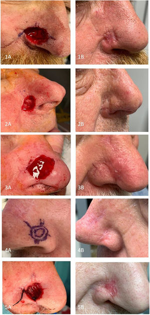 A) Fotografía de los defectos quirúrgicos en el ala nasal de los cinco pacientes y B) al mes de la reconstrucción con IDG.