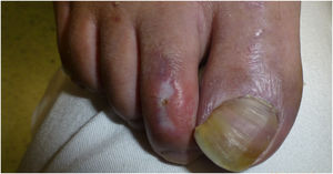 Multiple well-demarcated, depressed, porcelain-white plaques with a peripheral erythematous–violaceous halo on the dorsum of the toes.