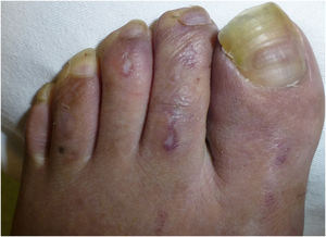 Detail of a Degos disease-like, depressed, porcelain-white plaque in second toe.