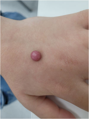 Solitary pink nodule on the dorsum of the left hand.