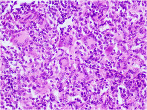 The nodule is mainly composed of Touton-type multinucleated giant cells (hematoxylin–eosin, magnification 400×).