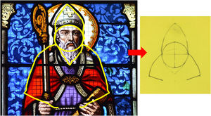 Diseño del colgajo obispo, donde el triángulo superior de la isla de pedículo subcutáneo corresponde a la mitra, el triángulo de Burow inferior es la barba y los colgajos laterales en hacha son los hombros y brazos del obispo.
