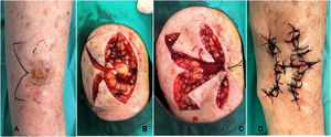 A) Diseño del colgajo sigma en un paciente con un carcinoma espinocelular en la pierna. B) Extirpación en huso de la lesión e incisión de los dos colgajos en hacha. C) Rotación de ambos colgajos en hacha. D) Sutura final.