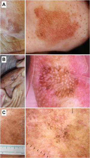 Queratosis actínicas pigmentadas. A) Queratosis actínica pigmentada en la pirámide nasal de una mujer de 70 años. En la dermatoscopia se aprecia un patrón anular/granular, eritema y folículos prominentes. B) Queratosis actínica pigmentada en el hélix de un varón de 85 años. Con dermatoscopia se observa un área marrón sin estructura, eritema y múltiples «rosetas». C) Queratosis actínica pigmentada en la sien de un varón de 56 años. En el examen dermatoscópico pueden verse escamas pigmentadas y folículos prominentes/«rosetas».
