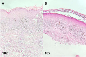 Tanto (A) como (B) muestran hiperqueratosis, hipergranulosis, hiperplasia epitelial con infiltrado linfoide de tendencia liquenoide y presencia de melanófagos en la dermis papilar.