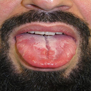 Pequeños parches redondeados en dorso de lengua junto con placas depapiladas de mayor tamaño típicos de la sífilis secundaria.