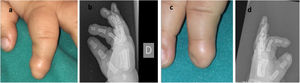 Síndrome de Iso-Kikuchi. a y c) Anoniquia del segundo dedo de la mano derecha y mínimo esbozo de uña en el de la mano izquierda. b y d) Radiografía simple donde se observa una escotadura en forma de «Y» a nivel de la falange distal de ambos dedos.