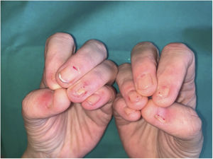 Enfermedad de Fong o síndrome de uña-rótula. Hipoplasia ungueal del primer, segundo, cuarto y quinto dedos de ambas manos con las características lúnulas triangulares en los terceros dedos. Además, se observa cómo la lámina ungueal del segundo, cuarto y quinto dedos de ambas manos no alcanzan el borde libre del dedo.