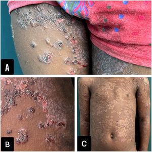 Clinical photographs. A and B) Thighs with tense blisters and hemorrhagic crusts distributed in rosettes. C) Residual hypopigmented macules, with a rosette pattern.