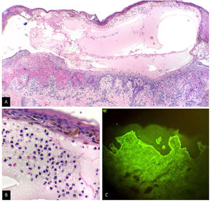 Skin biopsy. A) Subepidermal blister, H&E×4. B) Neutrophil-rich inflammatory infiltrate, H&E×40. C) Direct immunofluorescence, H&E×40. IgA+ in a linear pattern at the basement membrane zone.