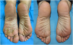 Dyshidrotic eczema on the soles of the feet and toe pulp with complete improvement after 2 months on dupilumab.