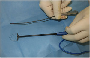 Surgical material required for deroofing a hidradenitis suppurativa fistula: a stylet and a gynecological diathermic conization loop.