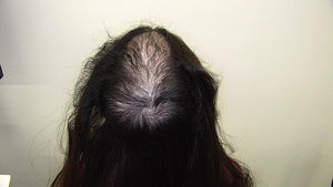 Alopecia extensa difusa en región interparietal y vértex en mujer joven secundaria a tricotilomanía.